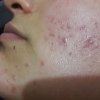 Evkur Alışveriş Duaderm Cilt Bakım Şikayet