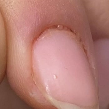 Ruj Nail Bar Manikür Sonucu Enfeksiyon