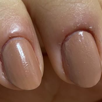 Ruj Nail Bar Manikür Sonucu Enfeksiyon