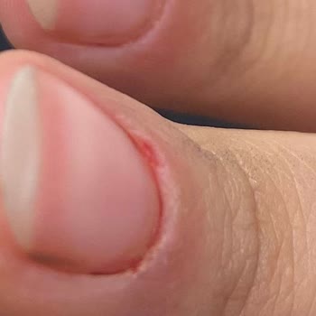 Ruj Nail Bar Manikür Sonucu Enfeksiyon