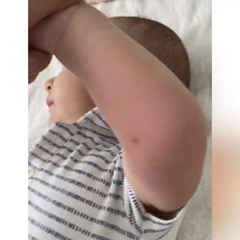 Dalin Islak Mendil Yüzde Ve Vücutta Kızarıklık