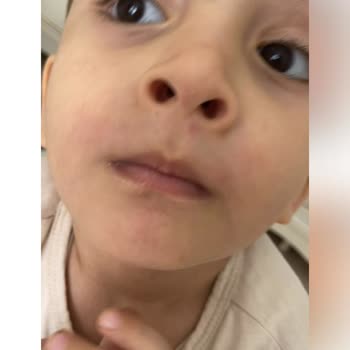 Dalin Islak Mendil Yüzde Ve Vücutta Kızarıklık