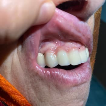 Dt. Baran Güneri İmplant Yapamıyor