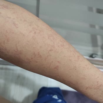 Özel Naturaslim Polikliniği Lazer Yaptırdım Ve Yanıklar Oluştu