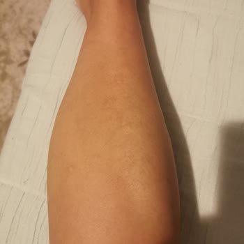 Lavinya Golden Antalya Bacağımda Yanık Var