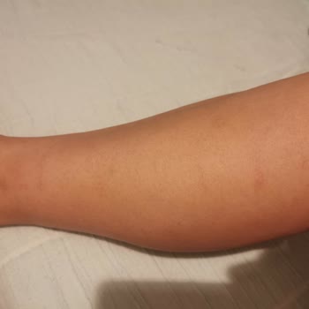 Lavinya Golden Antalya Bacağımda Yanık Var