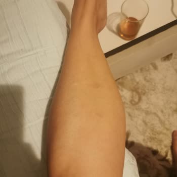 Lavinya Golden Antalya Bacağımda Yanık Var