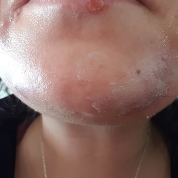 Dilan Polat Estetik Berces Mamak Şube Şikayet