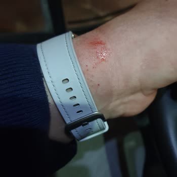 Samsung Kordonun Ciltte Yaptığı Tahribat.