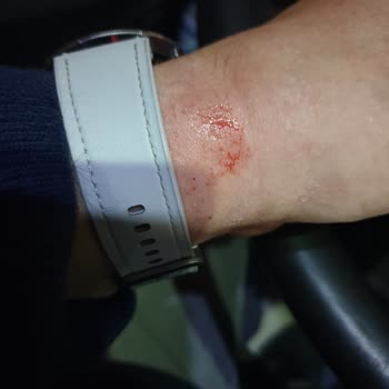 Samsung Kordonun Ciltte Yaptığı Tahribat.