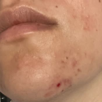 Nish Estetik Güzellik Merkezinde Yaşanan Cilt Bakımı Problemi