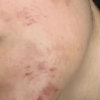 Nish Estetik Güzellik Merkezinde Yaşanan Cilt Bakımı Problemi