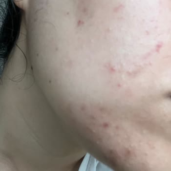 Nish Estetik Güzellik Merkezinde Yaşanan Cilt Bakımı Problemi