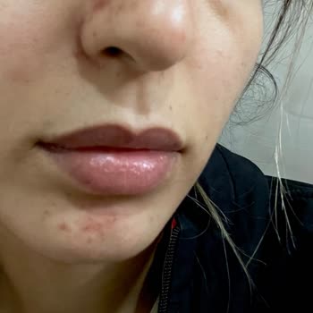 Nish Estetik Nish Estetic Güzellik Bakımında Yaşanan Cilt Bakım Problemi