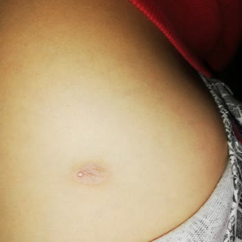 Kaş Tıp Merkezi Yanlış İğne Nedeniyle Doku Kaydı