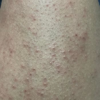 Veet Men Tahriş Ve Kaşıntı