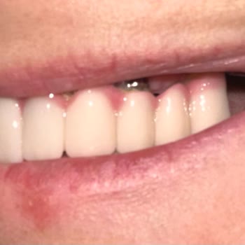 Novus Klinik Yanlış Yapılan Diş Protezi