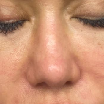 Sante Plus Hastanesi Sante Plus Zeytinburnu Rinoplasti Mağduriyeti