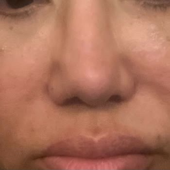 Sante Plus Hastanesi Sante Plus Zeytinburnu Rinoplasti Mağduriyeti