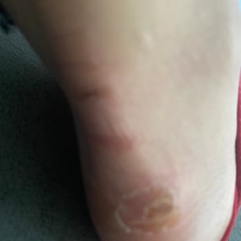 Puma Ayakkabı Ayağı Vurması