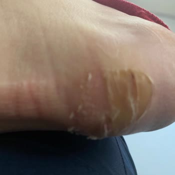 Puma Ayakkabı Ayağı Vurması