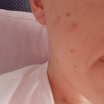Kiperin Collageni Sivilce Yapıyor.