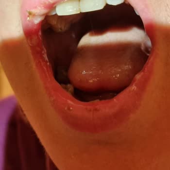 Sensodyne Hassas Dişler Ve Diş Eti Ağız Yarası