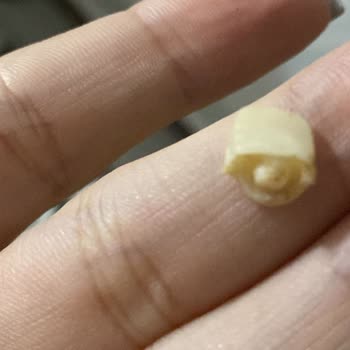 Dt. Murat Sahip (Sahipclinic) Yanlış Tedavi Yüzünden Kendi 2 Ana Dişimde Kırıldı