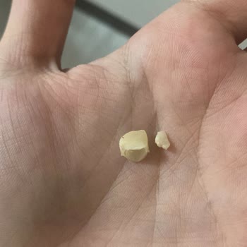 Dt. Murat Sahip (Sahipclinic) Yanlış Tedavi Yüzünden Kendi 2 Ana Dişimde Kırıldı