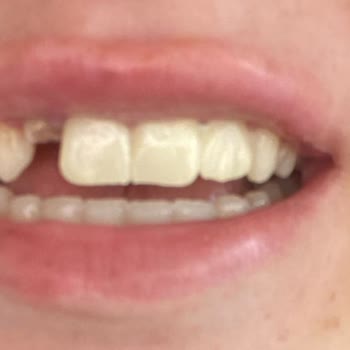 Dt. Murat Sahip (Sahipclinic) Yanlış Tedavi Yüzünden Kendi 2 Ana Dişimde Kırıldı