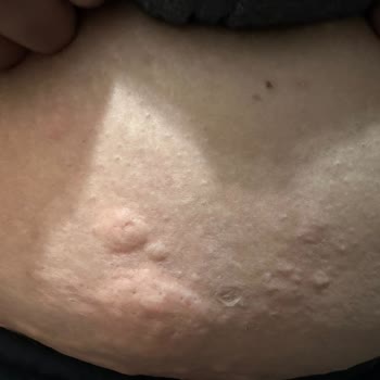 Bella World Epilasyon Sonrası Oluşan Giderek Yaralar Kaşıntı