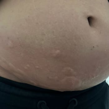 Bella World Epilasyon Sonrası Oluşan Giderek Yaralar Kaşıntı