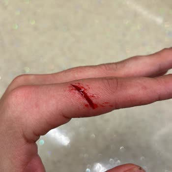 Epc Hastanesi Dikiş Atmayı Bilmiyorum Diyen Doktor