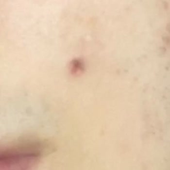 Kayseri Devlet Hastanesi Cildiye Bölümü (Kalıcı İz Kaldı) Mağduriyeti