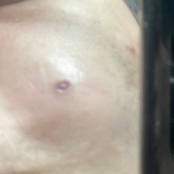 Kayseri Devlet Hastanesi Cildiye Bölümü (Kalıcı İz Kaldı) Mağduriyeti