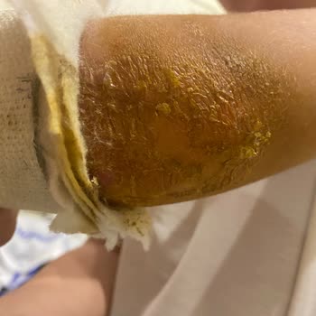 Ofm Antalya Hastanesi Ortopedi Doktoru Alçı