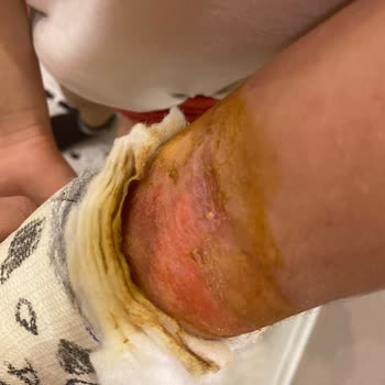 Ofm Antalya Hastanesi Ortopedi Doktoru Alçı