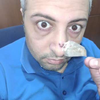 Novita Estetik Merkezi Olmayan Burun Estetiği