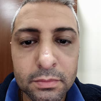 Novita Estetik Merkezi Olmayan Burun Estetiği