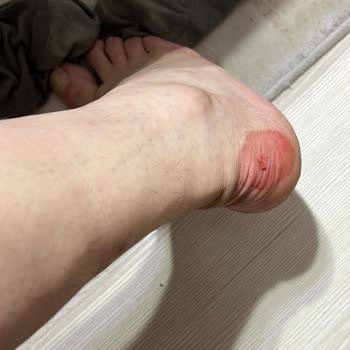 Skechers Ayakkabı (Bot) Vurması