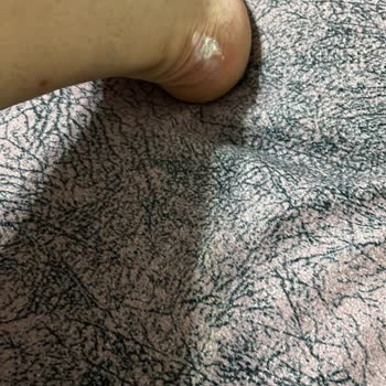 Skechers Ayakkabı (Bot) Vurması