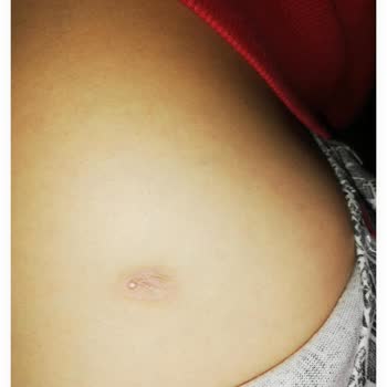 Yanlış İğneden Doku Kaydı Oldu