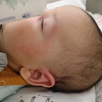 Mustela Bebek Kremi Bebeğimin Yüzünü Tahriş Etti