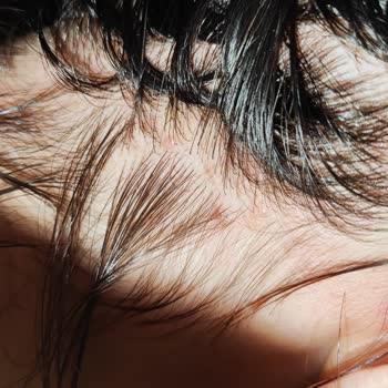 Kronos Kuaför Yüzünden Kopan Saçlarım, Kafamdaki Açılmalar