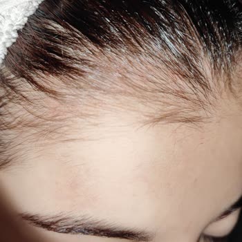 Kronos Kuaför Yüzünden Kopan Saçlarım, Kafamdaki Açılmalar