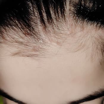 Kronos Kuaför Yüzünden Kopan Saçlarım, Kafamdaki Açılmalar