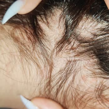 Kronos Kuaför Yüzünden Kopan Saçlarım, Kafamdaki Açılmalar