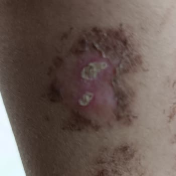 Moon Beauty Bar Lazer Epilasyonda 2 Derecede Yanıklarım Oldu