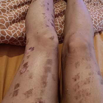 Moon Beauty Bar Lazer Epilasyonda 2 Derecede Yanıklarım Oldu