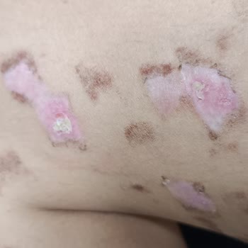 Moon Beauty Bar Lazer Epilasyonda 2 Derecede Yanıklarım Oldu